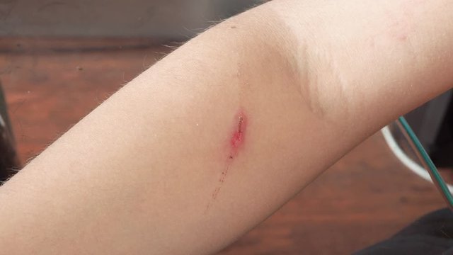 cut with blood on arm skin, disinfection wound on the arm