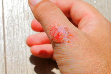 重度のアトピーに苦しむアレルギーを持つ男性の皮膚と指
