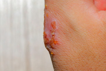 重度のアトピーに苦しむアレルギーを持つ男性の皮膚と指
