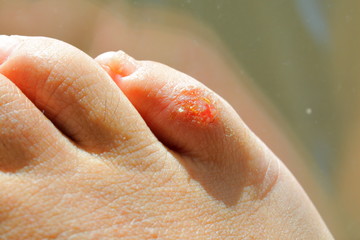 重度の水虫に苦しむアレルギーを持つ男性の血の付いた足と指
