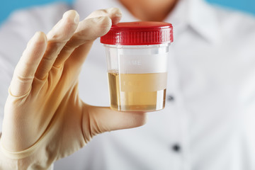 A doctor in a white coat holds a plastic container with yellow urine in his hand.