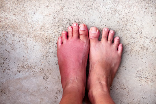 Woman left foot with red swelling from a bee sting on sister finger , inflammation allergy on skin old floor background top view