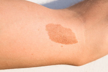 A large mole, birthmark on the skin of the arm of a young man.