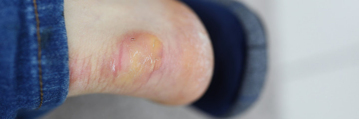 Close-up of male foot with dermatology problem. Macro shot of heel with callus and dry unhealthy skin. Trouble with new uncomfortable shoes. Salon treatment needed concept