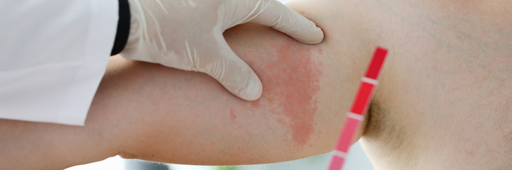 Fototapeta premium Close-up of doctor dermatologist doing test of body stain. Allergic urticaria on dermal edema Quincke spot with rim. Medicine and laboratory research concept