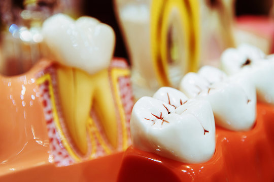 Plastic model of human teeth with caries. Close-up