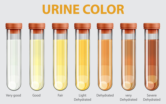 Urine color chart. Vector test tubes with different colors of urine or pee  depicting hydrated and dehydrated samples. Light and dark yellow, amber,  brown, and red urine. Medical test analysis. Stock Vector