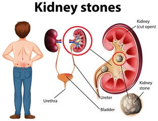 Comparison of healthy kidney and kidney with stones