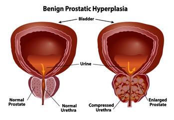 Prostate normal and enlarged. Benign prostatic hyperplasia with compressed urethra. Realistic style isolated on white background.
