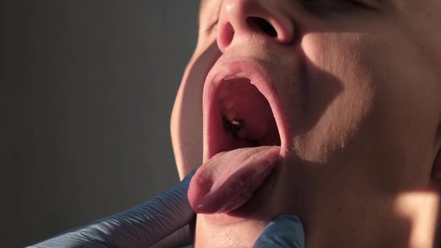 A doctor wearing protective gloves examines the patient's mouth or throat