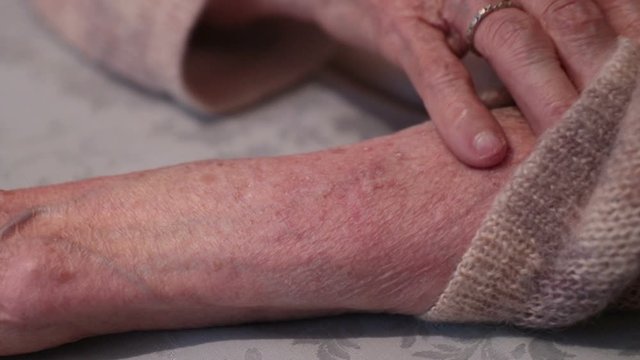 Eczema Pain. Senor Female Is Scratching Her Arm (panning Shot)