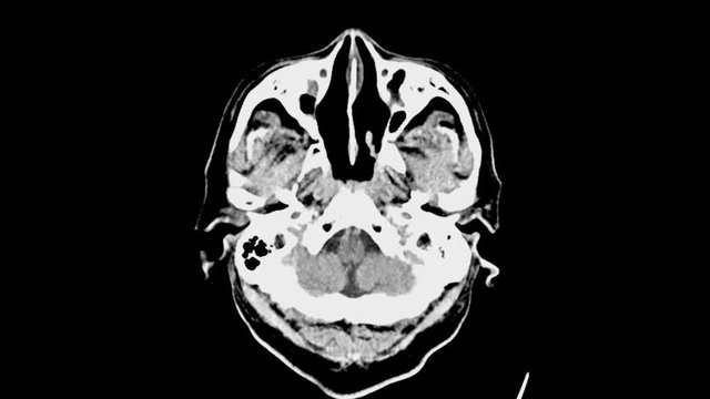 CT scan of brain showing intracerebral hemorrhage.