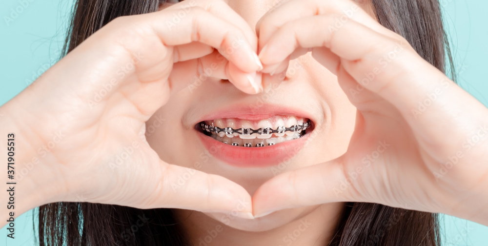 Wall mural Dental braces of young asian woman wearing braces with white teeth concept.