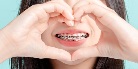 Dental braces of young asian woman wearing braces with white teeth concept.