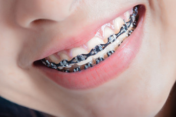 Dental braces of young asian woman wearing braces with white teeth concept.
