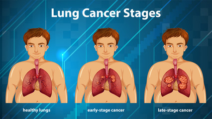 Informative illustration of lung cancer stages