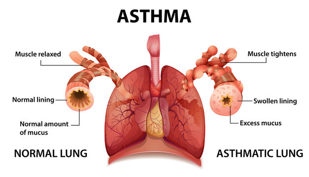 Human anatomy Asthma diagram
