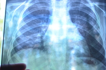 x ray image of human hand