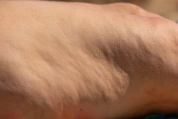 Naklejka premium cellulite on the female thigh as a background