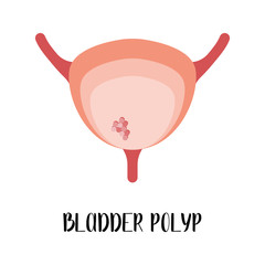 Bladder polyp. Bladder disease. Urology. Vector flat illustration. Perfect for flyer, medical brochure, banner, landing page, website