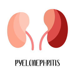 Pyelonephritis. Kidneys disease. Urology. Vector flat illustration. Perfect for flyer, medical brochure, banner, landing page, website