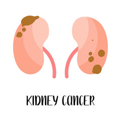 Kidney cancer, carcinoma. Oncology. Vector flat illustration, isolated on white. Perfect for flyer, medical brochure, banner, website