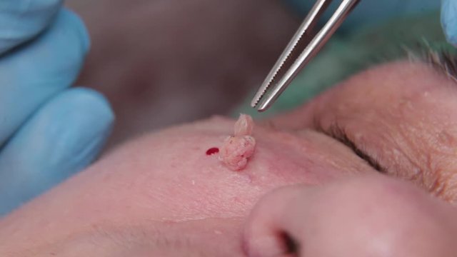 Male doctor removes papillomas of an elderly woman with an electric scalpel.
