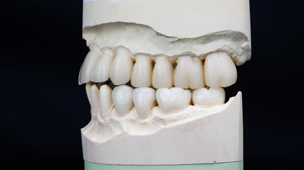 ceramic crowns on models of the upper and lower jaw in bite