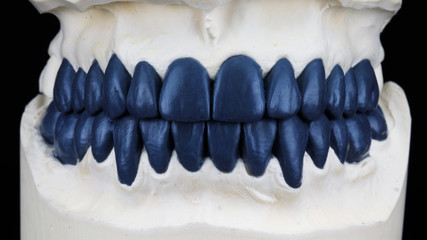 wax up of blue wax of the upper and lower jaws. models in bite on a black background