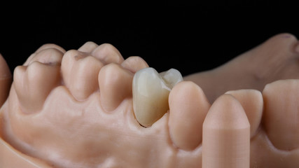 crown on a special resin model