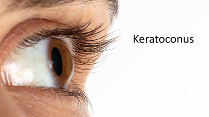 Macro eye photo. Keratoconus - eye disease, thinning of the cornea in the form of a cone. The cornea plastic. Close up, banner.