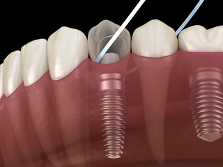 Implant tooth cleaning with dental floss. Medically accurate 3D illustration