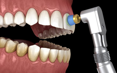 Teeth polishing procedure with professional brush and gel. Medically accurate 3D illustration