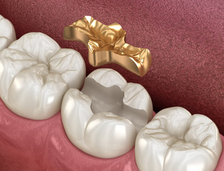 Golden Inlay crown fixation over tooth. Medically accurate 3D illustration of human teeth treatment