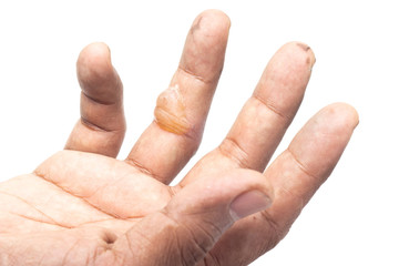 Blister injury at the finger of a worker caused by exposure to extreme hot