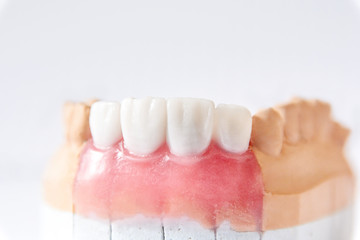 Denture made of ceramics located on plaster model