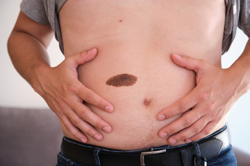 Big birthmark on young man belly skin. Imperfection and skin problems concept.