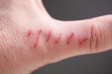 Finger with parallel scratches, many scratches on dark background