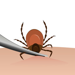 A tick is removed from the skin with tweezers. Tick bite. Vector illustration