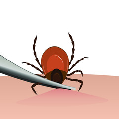 A tick is removed from the skin with tweezers. Tick bite. Vector illustration