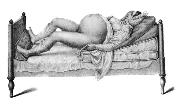 Pregnant woman on the bed in the old book Atlas Abildungen by D. W. Busch, Berlin, 1841
