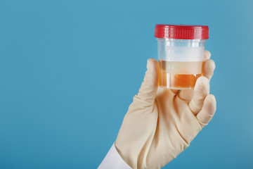 A container for biomaterial with a urine analysis in the hand of a doctor in a white rubber glove on a blue background.