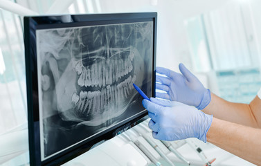 Hands doctor dentist in gloves show the teeth on x-ray on digital screen in dental clinic on light...