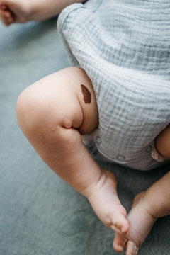 Detail of baby's legs with a birthmark