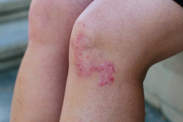 Closeup of the legs of a woman suffering from chronic psoriasis. Closeup of rash and scaling on the patient's skin. Dermatological problems. Dry skin.