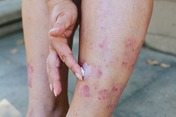 Fototapeta premium Application of therapeutic ointment for allergic rashes on the leg. Treatment of psoriasis, cosmetic and dermatological problems with ointment.
