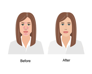 Woman Suffering from Seborrheic Dermatitis before and after medical treatment. Vector illustration. Adult or teenager face with skin problems isolated white background