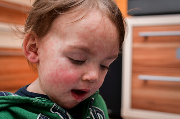 Children viral disease or allergies. Red measles rash on baby. - obrazy, fototapety, plakaty