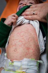 Children viral disease or allergies. Red measles rash on baby. - obrazy, fototapety, plakaty