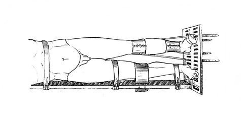 Leg fracture fixation in the old book The doctrine of fractures and dislocations by Nemmert, St. Petersburg, 1851